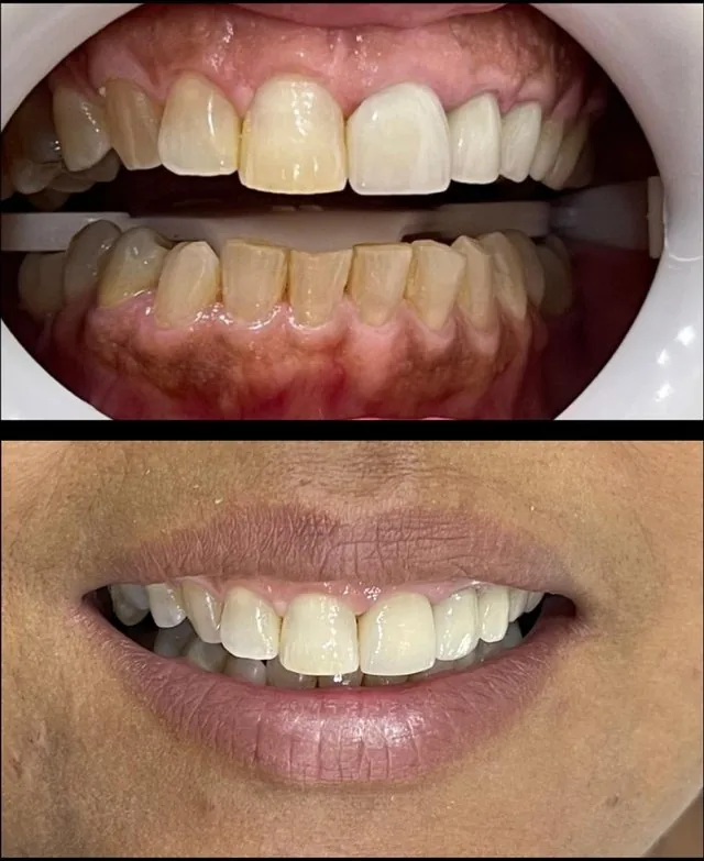 Antes e depois, caso real 3